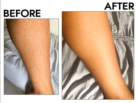 A before and after using the Billie Razor Starter Kit