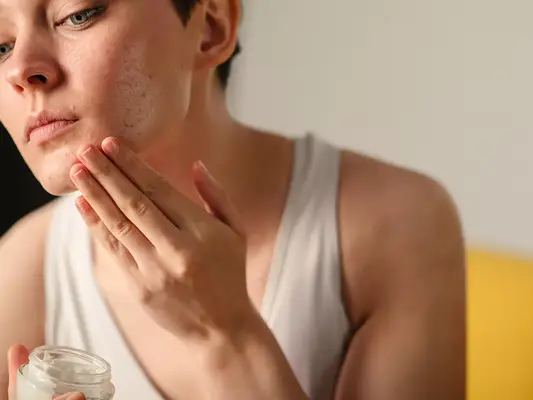 Portrait of a woman with short hair and acne applying a moisturizer