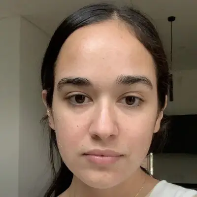 Microneedling with PRP Results Day 5