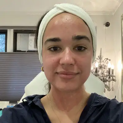 Microneedling with PRP Results Immediate