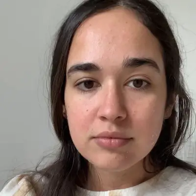 Microneedling with PRP Results Day 3