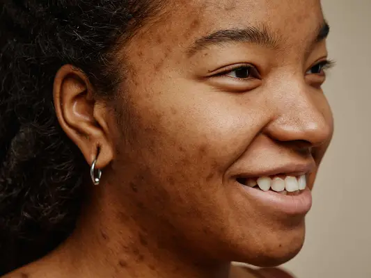  young woman with acne scars on face smiling
