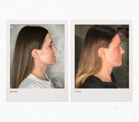 forma laser review—Sacha Strebe