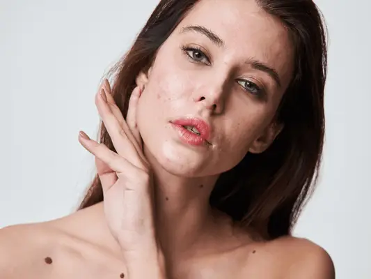 Sådan behandles komedonal acne ifølge hudlæger