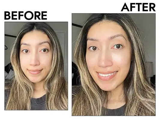 Photos of person’s face before and after using The Ordinary 100% Organic Cold-Pressed Rose Hip Seed Oil