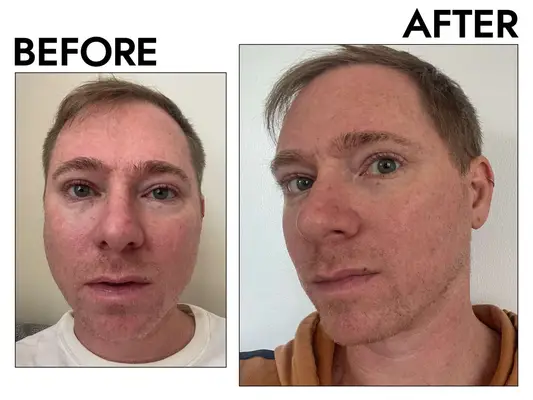 Person washing their face with cleanser