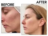 Sacheu Beauty Gua Sha before and after