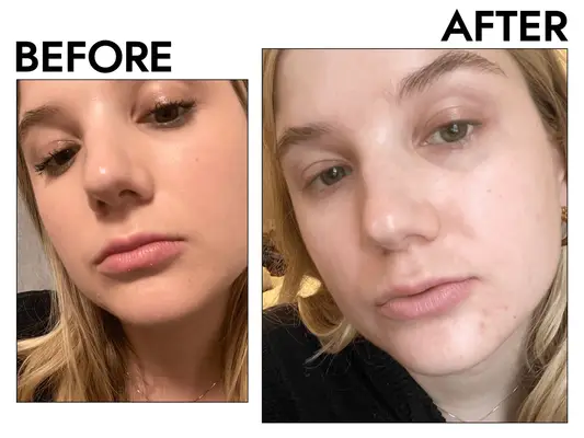 the author before and after trying Dr. Idriss Lip Baste