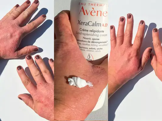A collage of a tester showing their before and after skin results using the Avène XeraCalm A.D Lipid-Replenishing Cream
