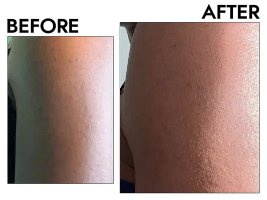 Person squeezing PanOxyl Maximum Strength Antimicrobial Acne Foaming Wash for Face onto hand