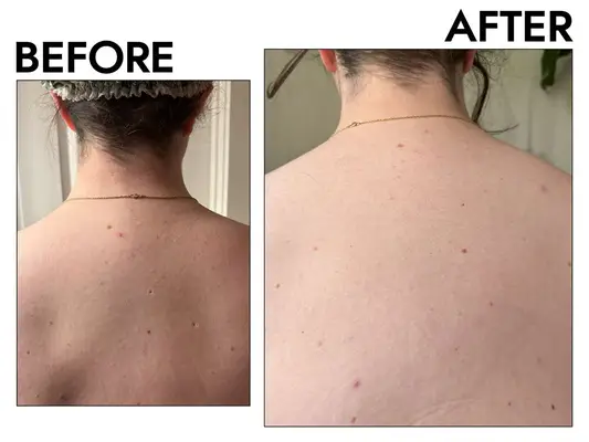 Amazon Cetaphil Acne Relief Body Wash