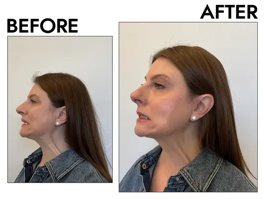 Before and after image of a woman who injected botox into her neck