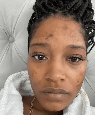 Keke Palmer makeup-free selfie with acne