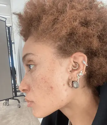 Adwoa Aboah instagram selfie with acne