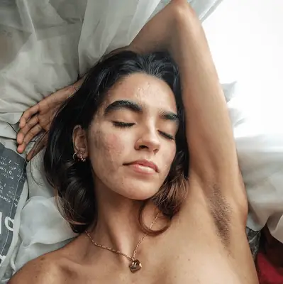 Brunette girl with damp hair, clean face and acne 