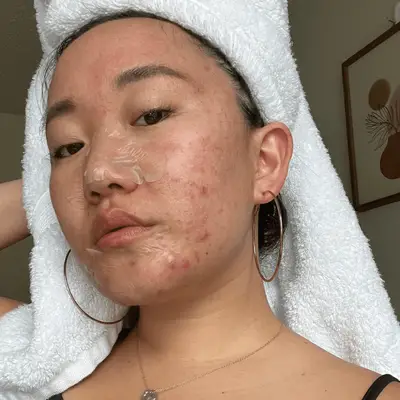 Girl with red hair and acne breakouts on chin