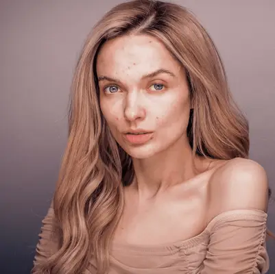 Chloe Barcelou with acne