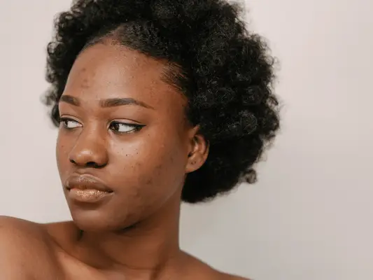 13 images inspirantes qui prouvent l'acné n'est pas laide