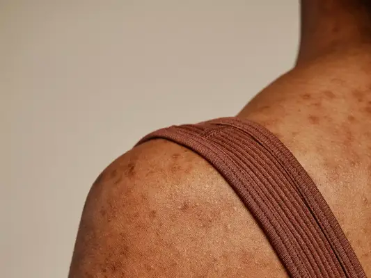 Die häufigen Ursachen von Bacne - und wie man es anspricht