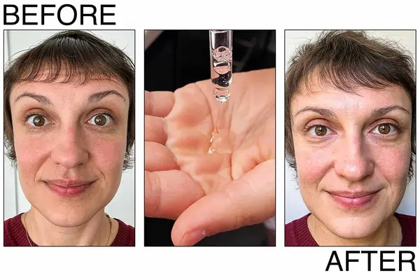 Ordinary Hydluronic Acid Before and After testing