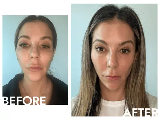 Acure Brightening Glowing Serum Before During and After Being Tested On Persons Face