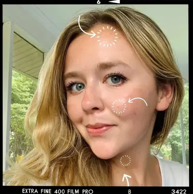 woman with moles on face