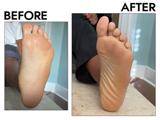 Photos of person’s foot before and after using DERMORA Foot Peel Mask