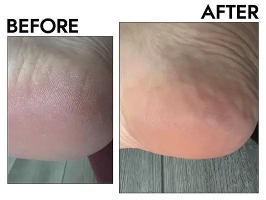 Photos of person’s heel before and after using Grace & Stella Dr. Pedicure Foot Peeling Mask
