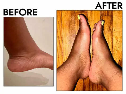 Photos of person’s feet before and after using Baby Foot Exfoliation Foot Peel