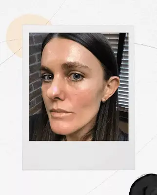 before under-eye fillers—Sacha Strebe