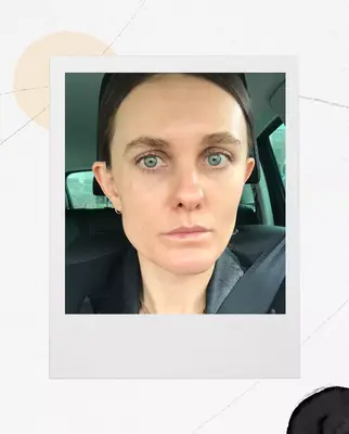 after under-eye fillers—Sacha Strebe