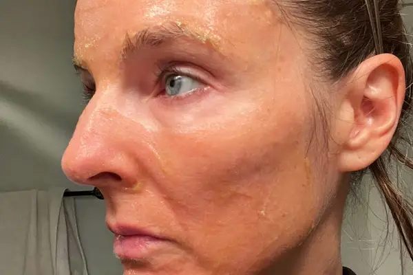Person with Peter Thomas Roth Pumpkin Enzyme Mask Enzymatic Dermal Resurfacer on their face