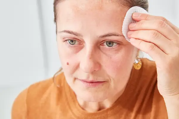 Person rubbing their forehead with a cotton round