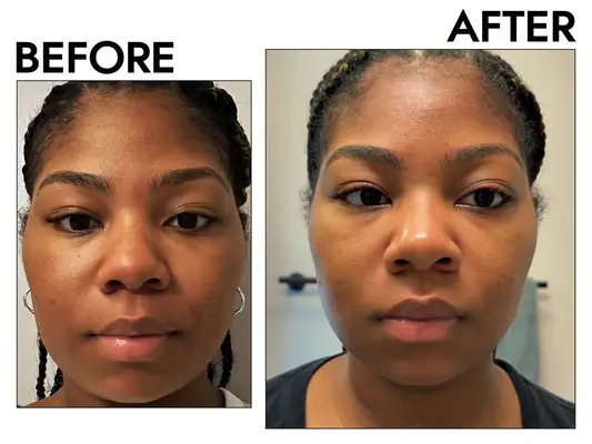 Before and After using Cetaphil Extra Gentle Daily Scrub