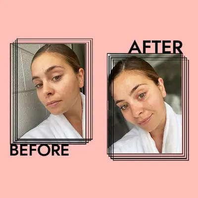 Avène Thermal Spring Water Results on Emily Algar