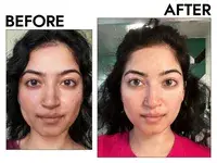 Photos of person’s face before and after using Macrene Actives High Performance Eye Cream