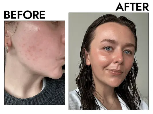 before and after photo of tretinoin for acne