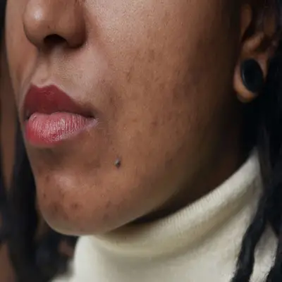 BIPOC girl with acne