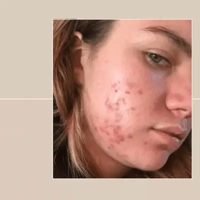 woman with acne on her face