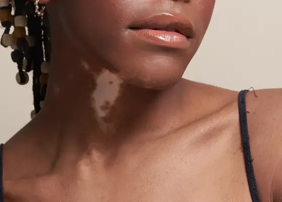 Come sbarazzarsi dell'acne toracica: 12 metodi approvati dal derma