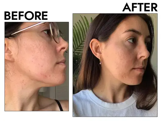 Photos of person’s face before and after using Mad Hippie Vitamin C Serum