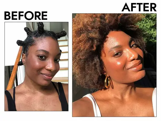 Photos of smiling person before and after using Differin Adapalene Gel 0.1% Acne Treatment