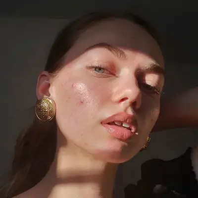 I migliori hack per sbarazzarsi di brufoli