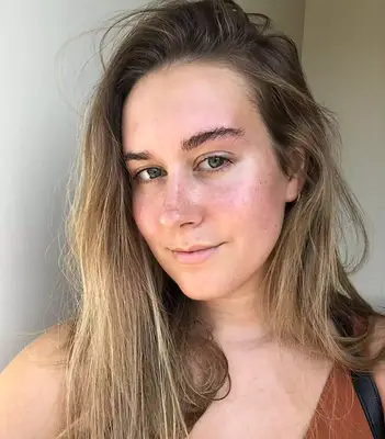 The author days after the facial