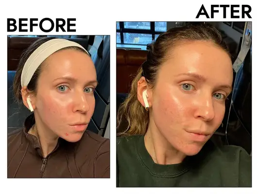 Newergreen Hero Cosemetic Mighty Patch showing before and after of breakout of skin