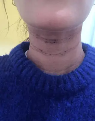 Picture of author after treatment