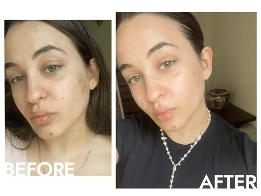 Woman before and after using the Medicube Age R Booster-H 