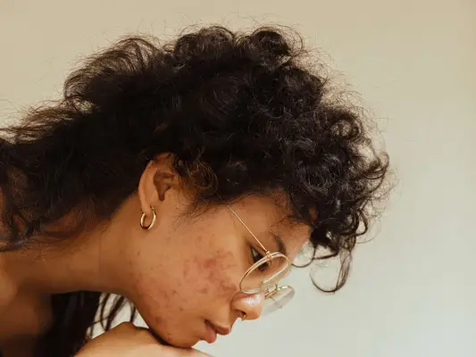 Close up of a person with adult acne, chin on their hand