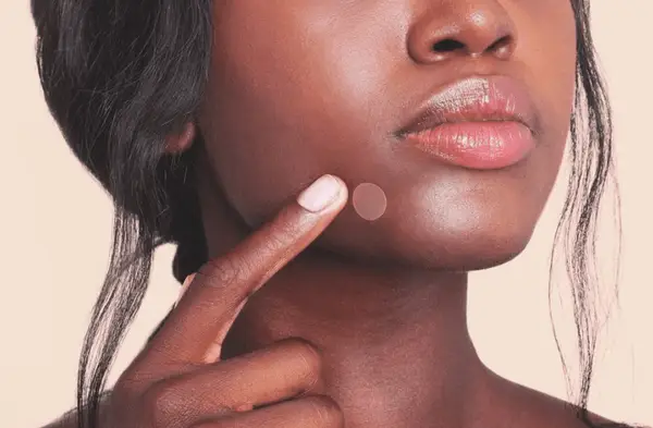 woman wearing pimple patch on lip
