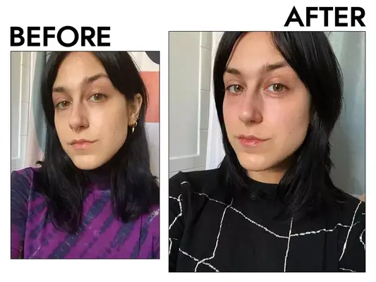 Photos of person’s face before and after using Truskin Vitamin C Facial Serum